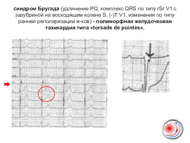 синдром Бругада (удлинение PQ, комплекс QRS по типу rSr V1 c зазубриной на