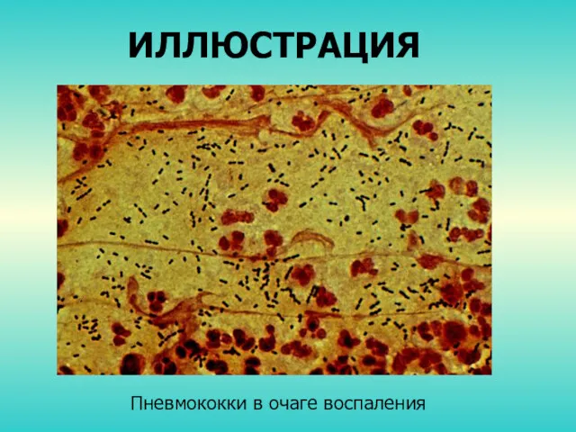 ИЛЛЮСТРАЦИЯ Пневмококки в очаге воспаления