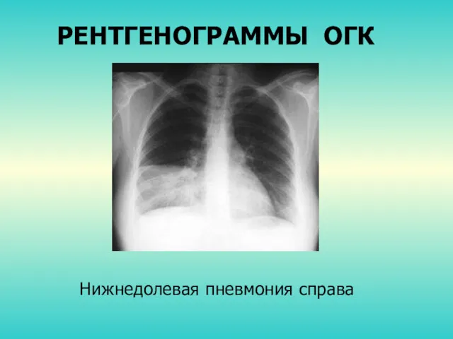 РЕНТГЕНОГРАММЫ ОГК Нижнедолевая пневмония справа