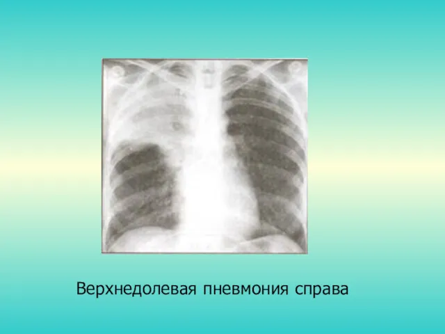 Верхнедолевая пневмония справа