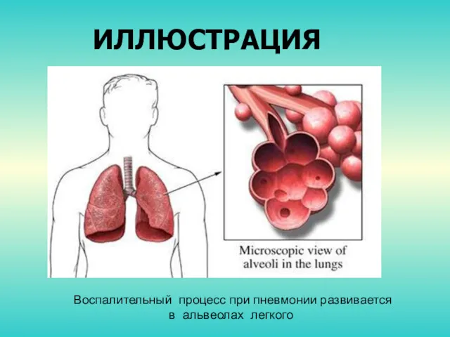 ИЛЛЮСТРАЦИЯ Воспалительный процесс при пневмонии развивается в альвеолах легкого