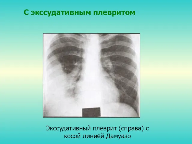 С экссудативным плевритом Экссудативный плеврит (справа) с косой линией Дамуазо