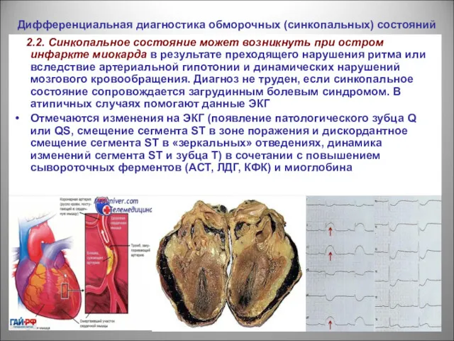Дифференциальная диагностика обморочных (синкопальных) состояний 2.2. Синкопальное состояние может возникнуть при остром инфаркте