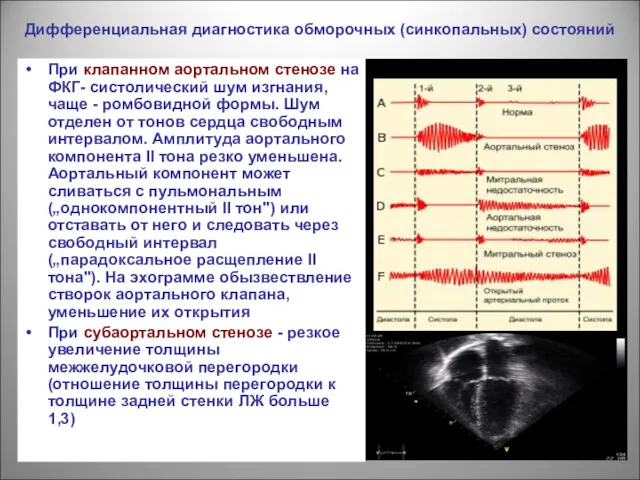 Дифференциальная диагностика обморочных (синкопальных) состояний При клапанном аортальном стенозе на ФКГ- систолический шум