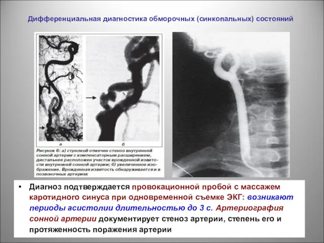 Дифференциальная диагностика обморочных (синкопальных) состояний Диагноз подтверждается провокационной пробой с