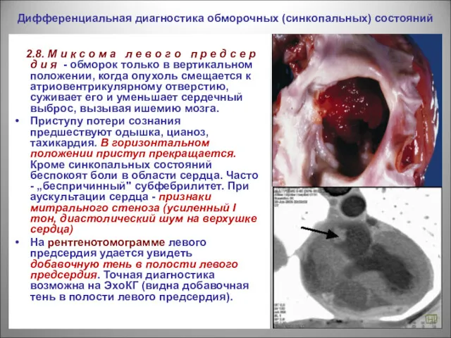 Дифференциальная диагностика обморочных (синкопальных) состояний 2.8. М и к с о м а