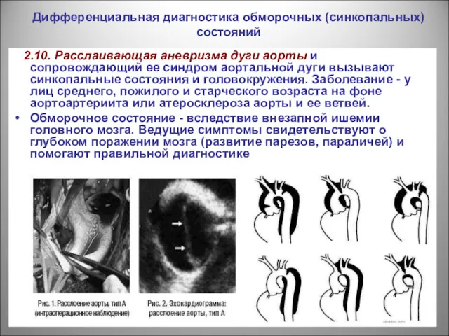 Дифференциальная диагностика обморочных (синкопальных) состояний 2.10. Расслаивающая аневризма дуги аорты и сопровождающий ее
