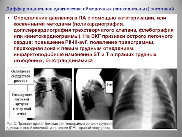 Дифференциальная диагностика обморочных (синкопальных) состояний Определение давления в ЛА с помощью катетеризации, или