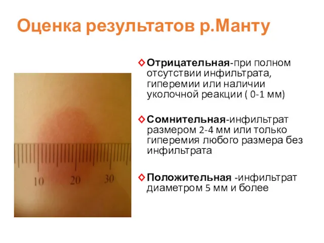 Оценка результатов р.Манту Отрицательная-при полном отсутствии инфильтрата, гиперемии или наличии