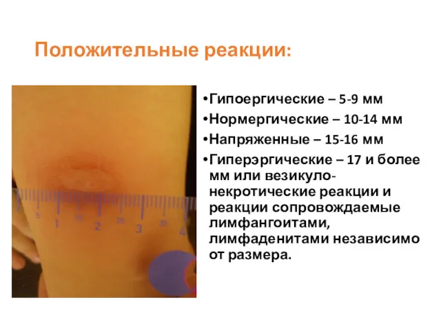 Положительные реакции: Гипоергические – 5-9 мм Нормергические – 10-14 мм