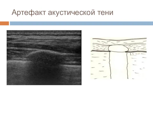 Артефакт акустической тени