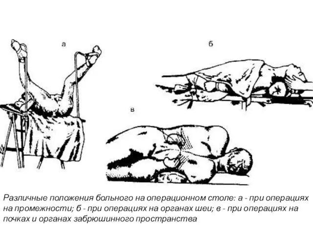 Различные положения больного на операционном столе: а - при операциях