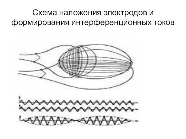 Схема наложения электродов и формирования интерференционных токов