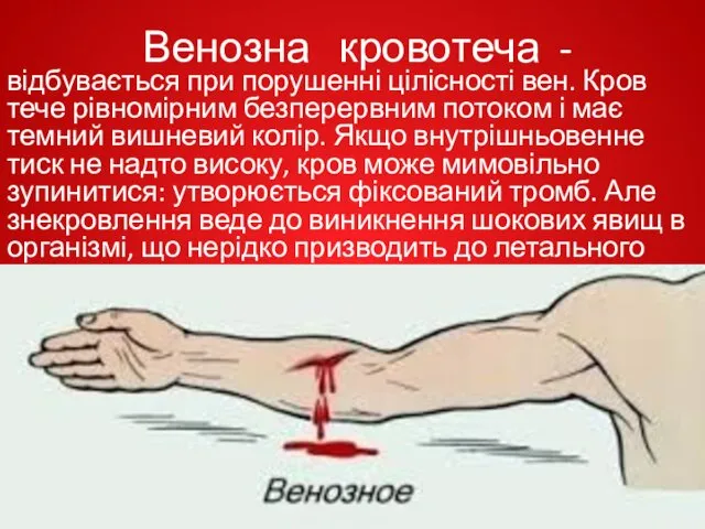 Венозна кровотеча - відбувається при порушенні цілісності вен. Кров тече