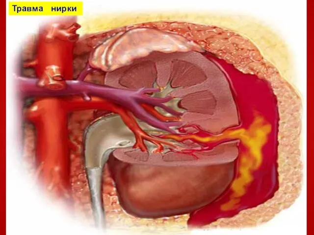 Травма нирки