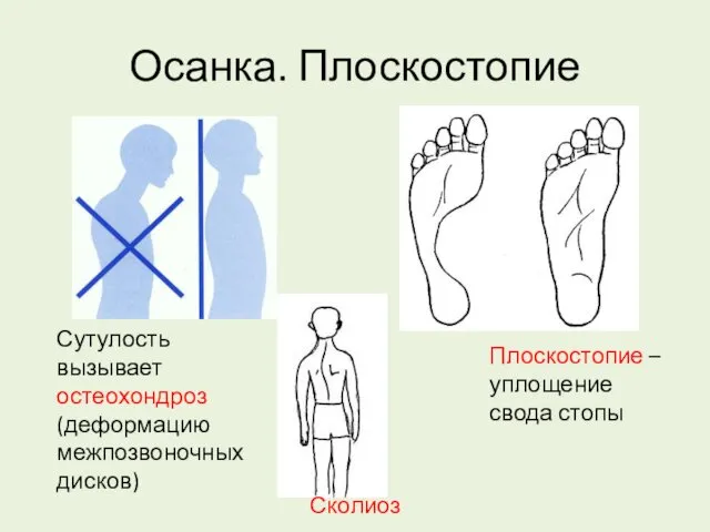 Осанка. Плоскостопие Сутулость вызывает остеохондроз (деформацию межпозвоночных дисков) Сколиоз Плоскостопие – уплощение свода стопы