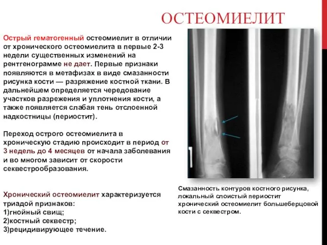 Острый гематогенный остеомиелит в отличии от хронического остеомиелита в первые 2-3 недели существенных