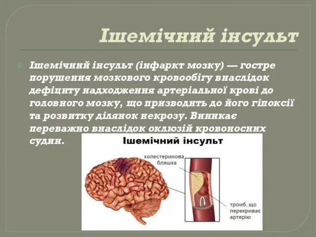 Ішемічний інсульт Ішемічний інсульт (інфаркт мозку) — гостре порушення мозкового