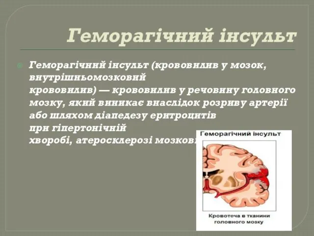 Геморагічний інсульт Геморагічний інсульт (крововилив у мозок, внутрішньомозковий крововилив) —