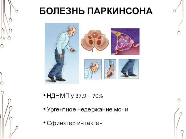 БОЛЕЗНЬ ПАРКИНСОНА НДНМП у 37,9 – 70% Ургентное недержание мочи Сфинктер интактен