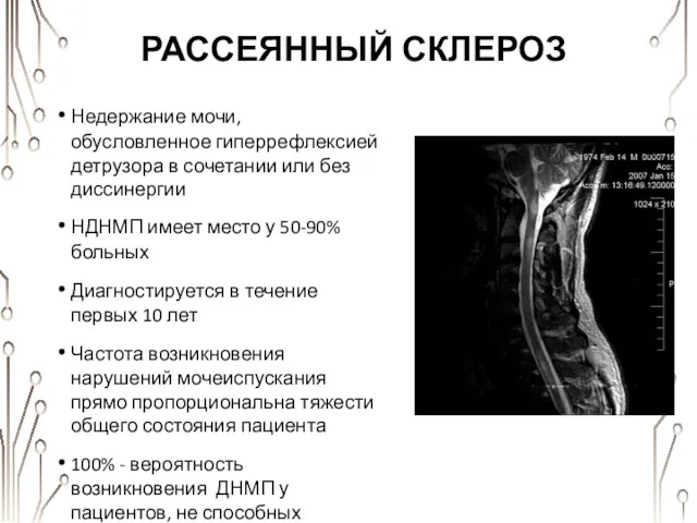 РАССЕЯННЫЙ СКЛЕРОЗ Недержание мочи, обусловленное гиперрефлексией детрузора в сочетании или