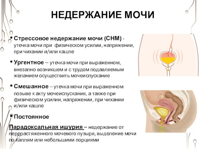 НЕДЕРЖАНИЕ МОЧИ Стрессовое недержание мочи (СНМ) - утечка мочи при