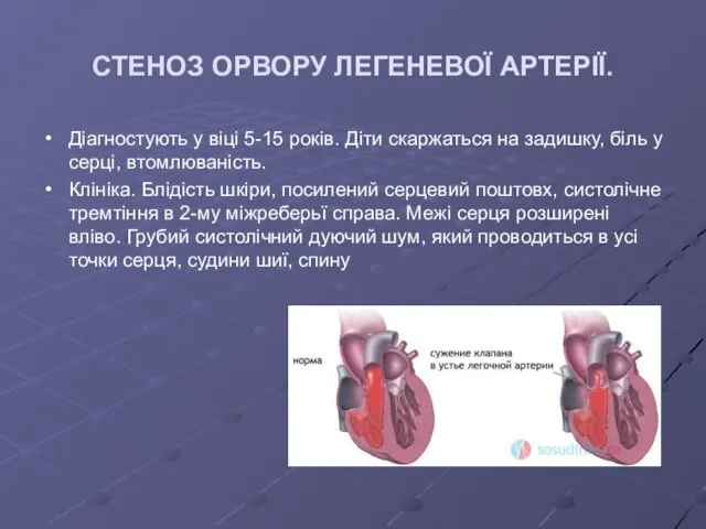 СТЕНОЗ ОРВОРУ ЛЕГЕНЕВОЇ АРТЕРІЇ. Діагностують у віці 5-15 років. Діти скаржаться на задишку,