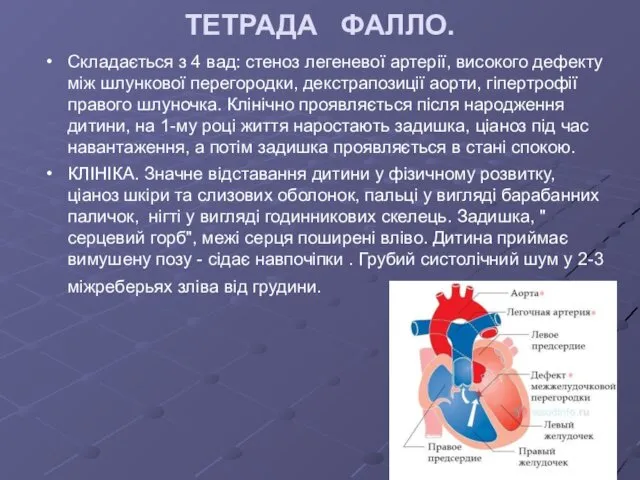 ТЕТРАДА ФАЛЛО. Складається з 4 вад: стеноз легеневої артерії, високого дефекту між шлункової