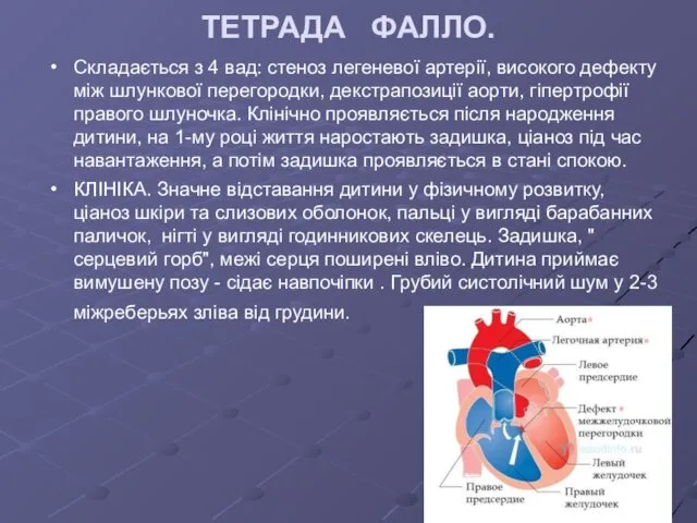 ТЕТРАДА ФАЛЛО. Складається з 4 вад: стеноз легеневої артерії, високого