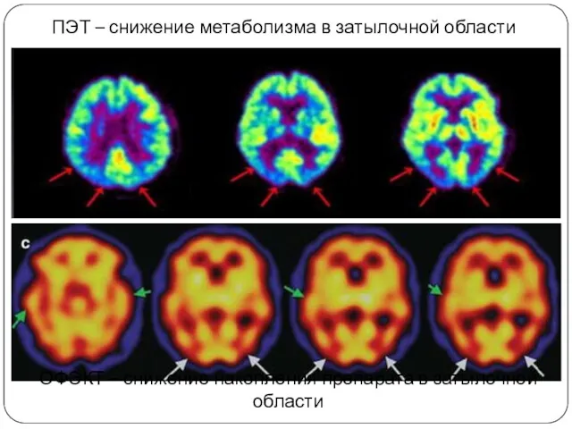 ПЭТ – снижение метаболизма в затылочной области ОФЭКТ – снижение накопления препарата в затылочной области