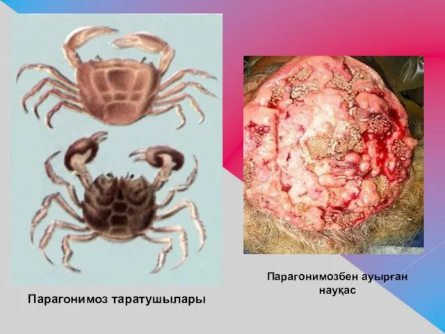 Парагонимоз таратушылары Парагонимозбен ауырған науқас