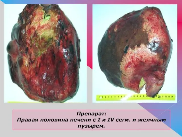 Препарат: Правая половина печени с I и IV сегм. и желчным пузырем.
