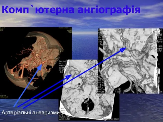 Комп`ютерна ангіографія Артеріальні аневризми