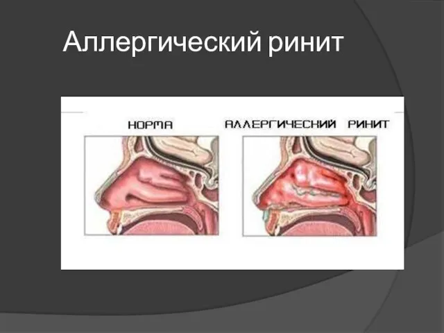 Аллергический ринит