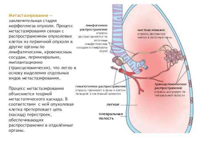 Метастазирование — заключительная стадия морфогенеза опухоли. Процесс метастазирования связан с