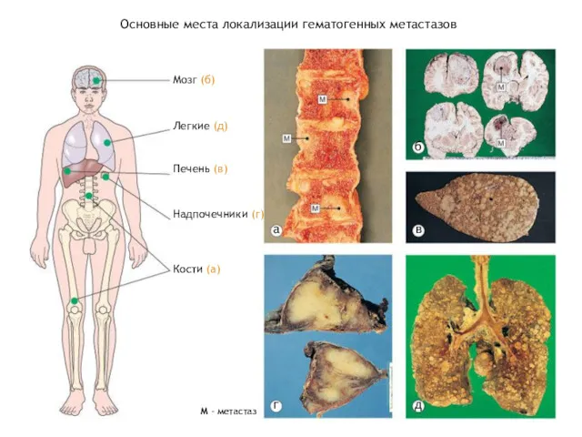 Основные места локализации гематогенных метастазов Мозг (б) Легкие (д) Печень