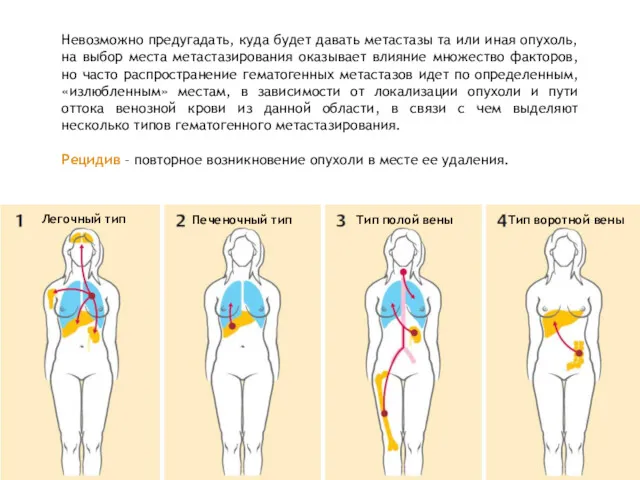 Невозможно предугадать, куда будет давать метастазы та или иная опухоль,