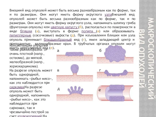 МАКРОСКОПИЧЕСКИЙ ВИД ОПУХОЛЕЙ Внешний вид опухолей может быть весьма разнообразным