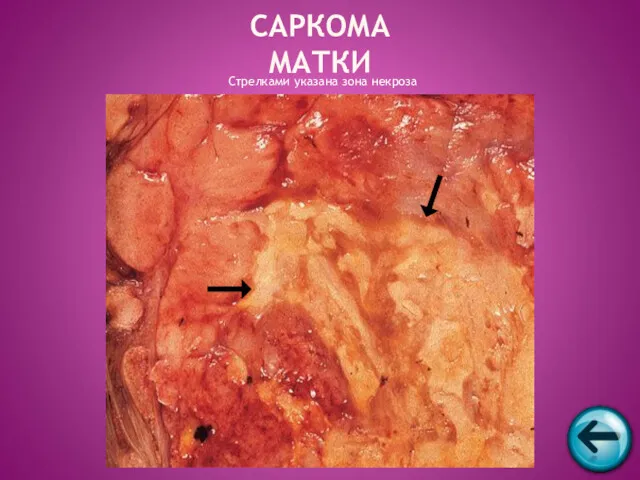 Стрелками указана зона некроза САРКОМА МАТКИ