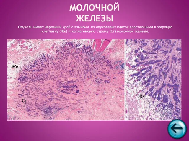 Опухоль имеет неровный край с языками из опухолевых клеток врастающими