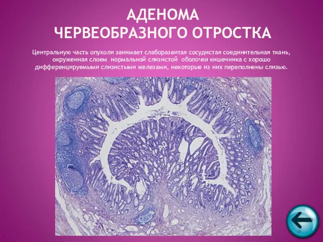 АДЕНОМА ЧЕРВЕОБРАЗНОГО ОТРОСТКА Центральную часть опухоли занимает слаборазвитая сосудистая соединительная