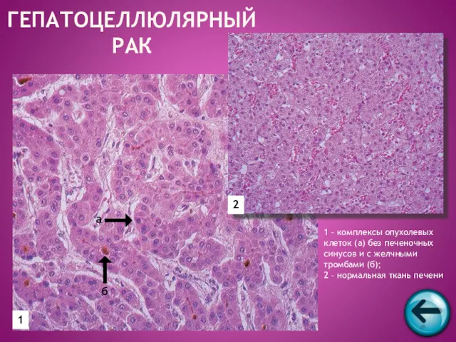 ГЕПАТОЦЕЛЛЮЛЯРНЫЙ РАК 1 2 а б 1 – комплексы опухолевых