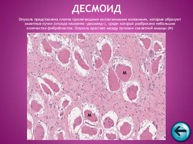 ДЕСМОИД Опухоль представлена плотно прилегающими коллагеновыми волокнами, которые образуют заметные