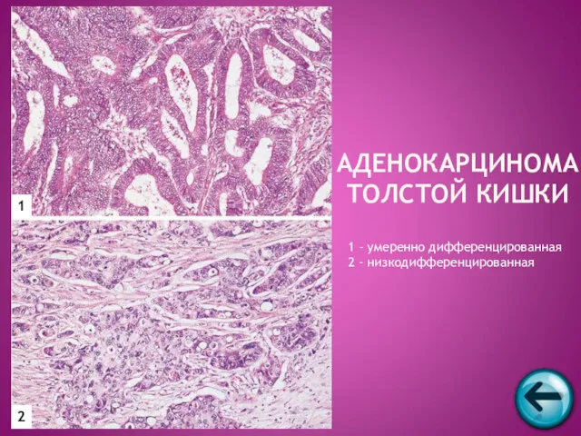 АДЕНОКАРЦИНОМА ТОЛСТОЙ КИШКИ 1 2 1 – умеренно дифференцированная 2 - низкодифференцированная