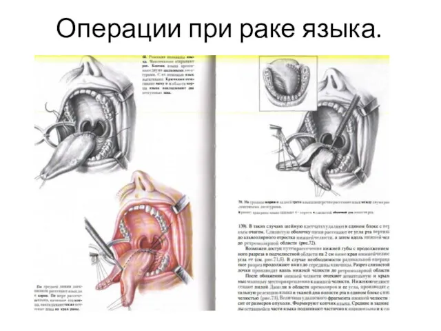 Операции при раке языка.