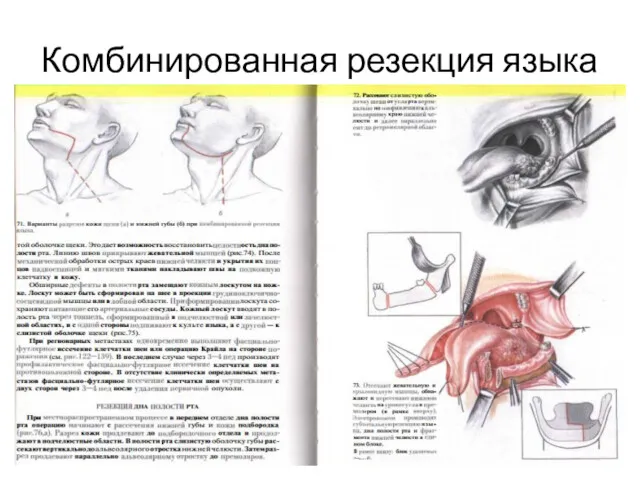 Комбинированная резекция языка