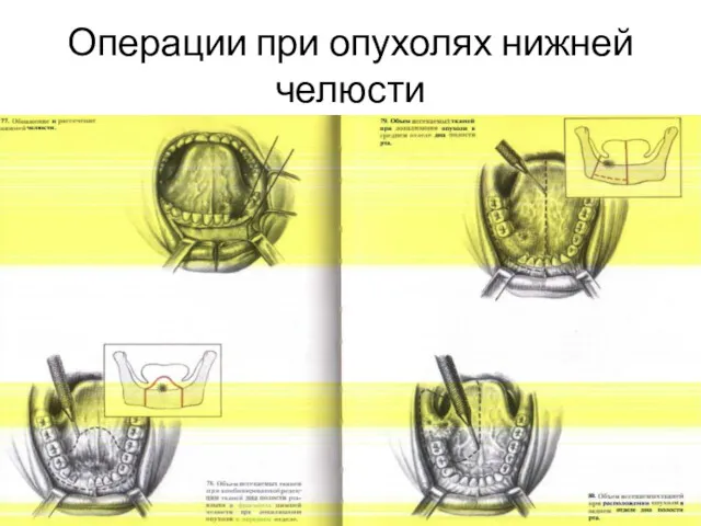 Операции при опухолях нижней челюсти