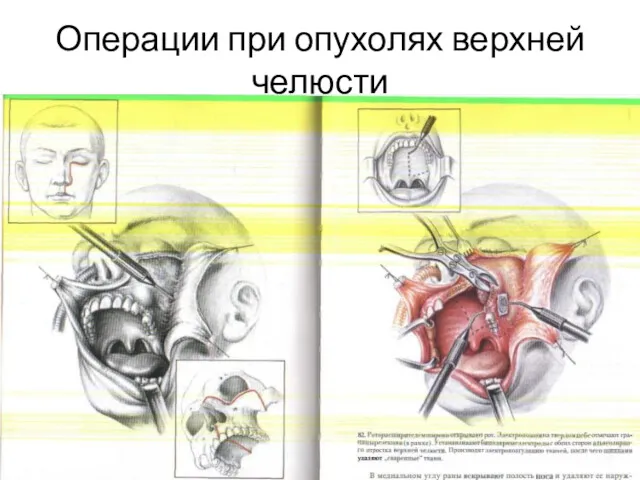 Операции при опухолях верхней челюсти