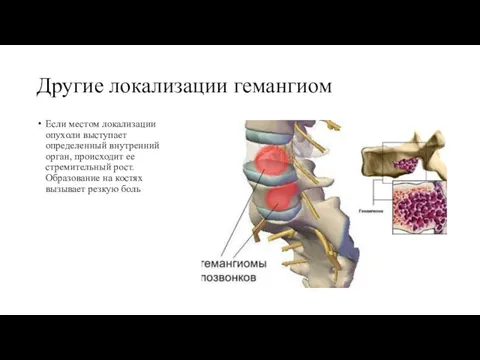 Другие локализации гемангиом Если местом локализации опухоли выступает определенный внутренний