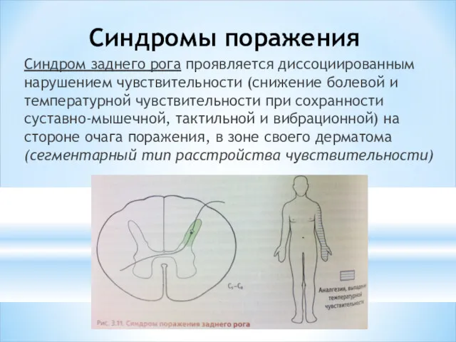 Синдромы поражения Синдром заднего рога про­является диссоциированным нарушением чувствительности (снижение